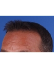 After Hair Transplant&nbsp;2 Sessions (Areas)
